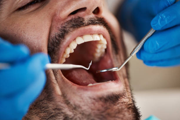 Best Emergency Dental Extractions in Whittier, CA